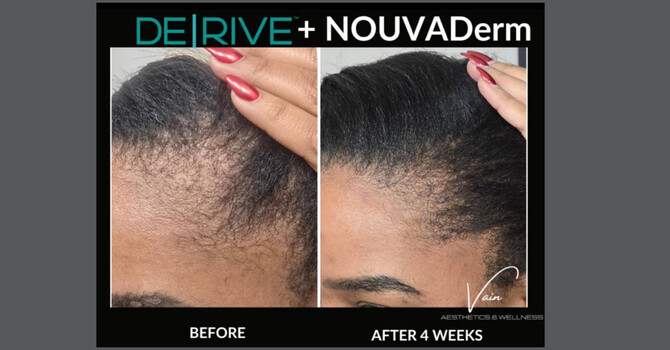 Laser Hair Restoration