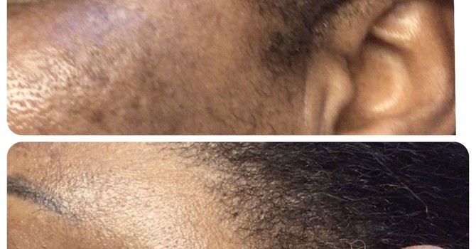 Understanding Melasma: Causes, Treatments, and What to Expect  image